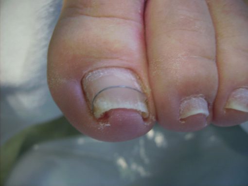 Ingegroeide nagel behandelen - Salon Miranda - Spijkenisse